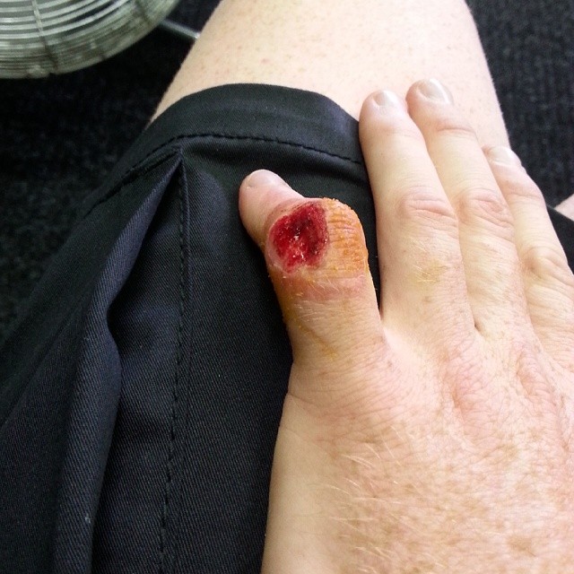 Травмированный палец Брэдли Смита Травмированный палец Брэдли Смита