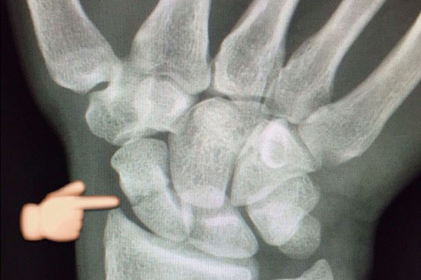 Ладьевидная кость