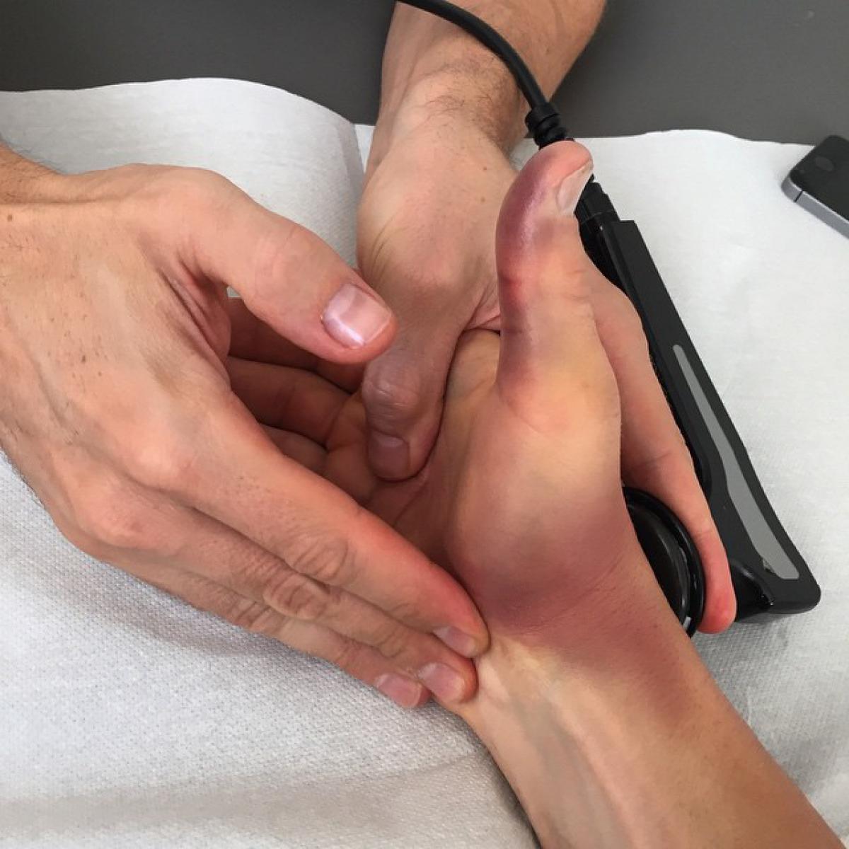 Ники Хэйден сломал палец на правой руке