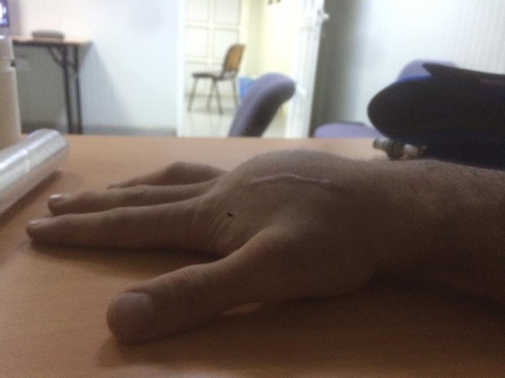 Опухшая рука Данило Петруччи