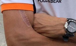 Марк Маркес, шрам